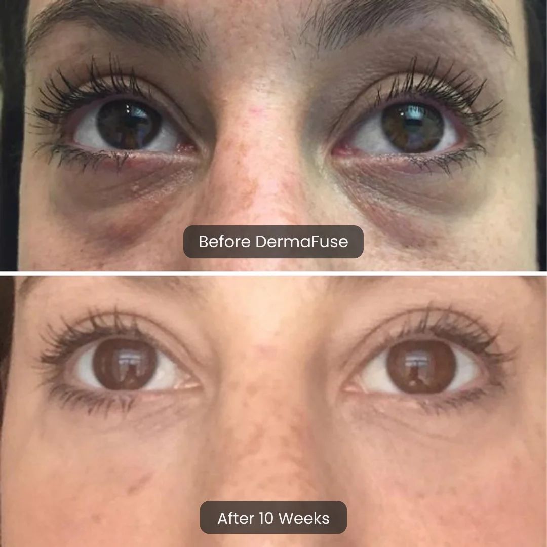 DermaFuse Patches