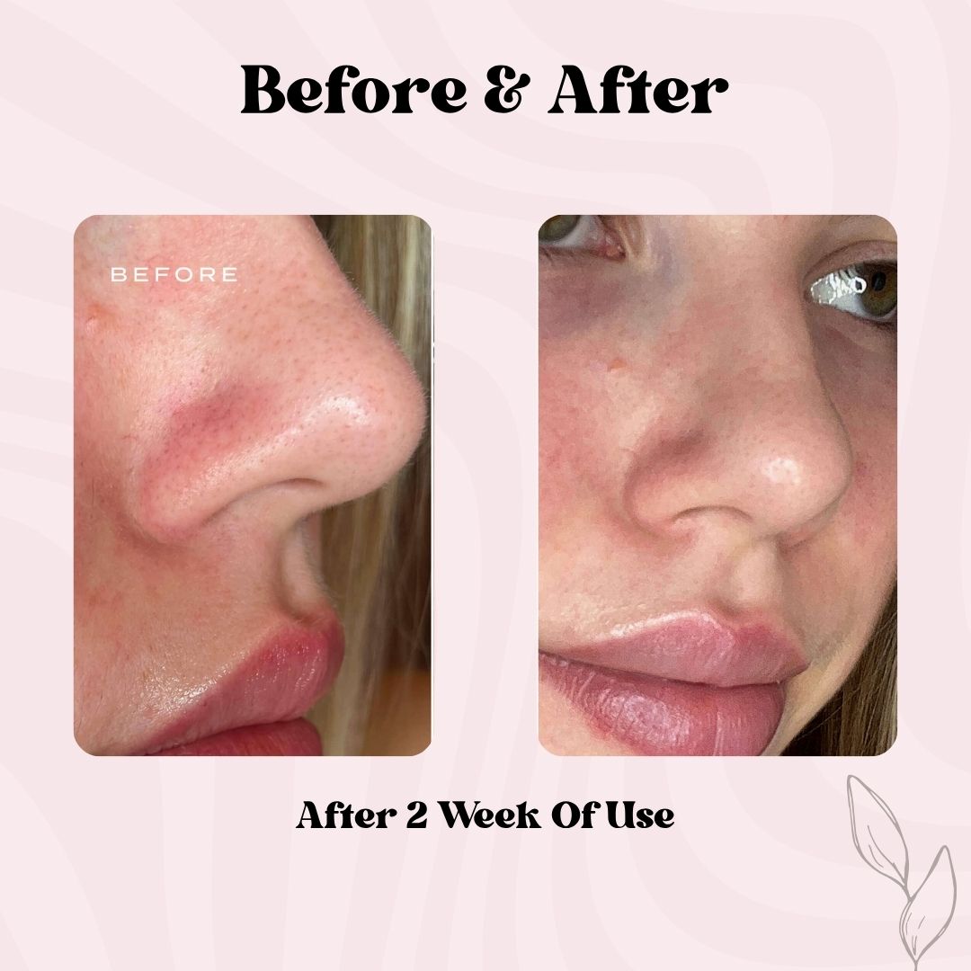 Clear Pore Patch