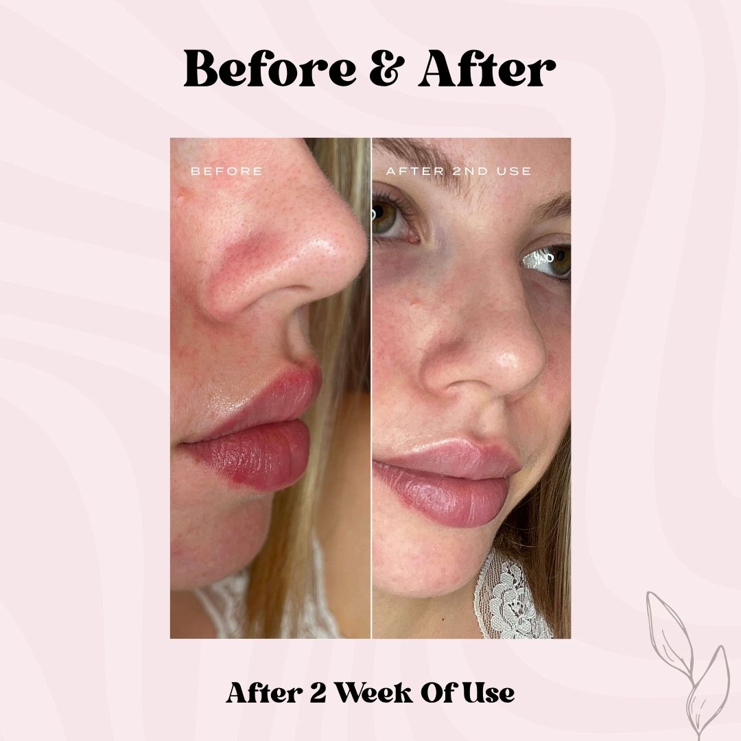 Clear Pore Patch