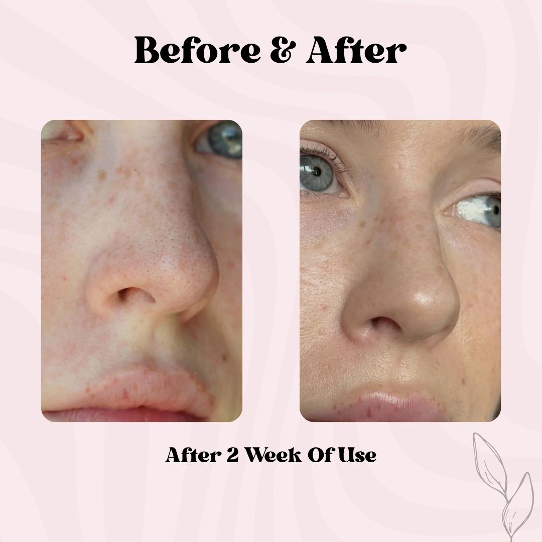 Clear Pore Patch