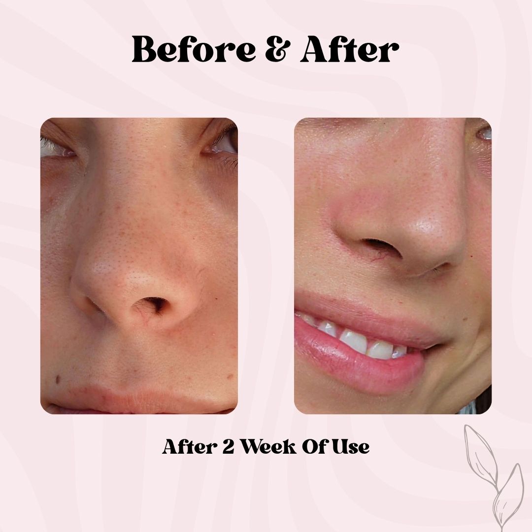 Clear Pore Patch