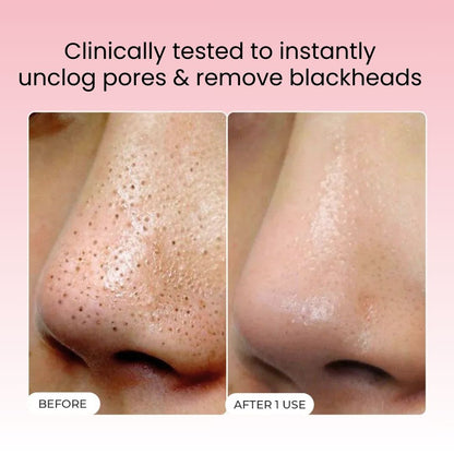 Blackhead Melting Softner