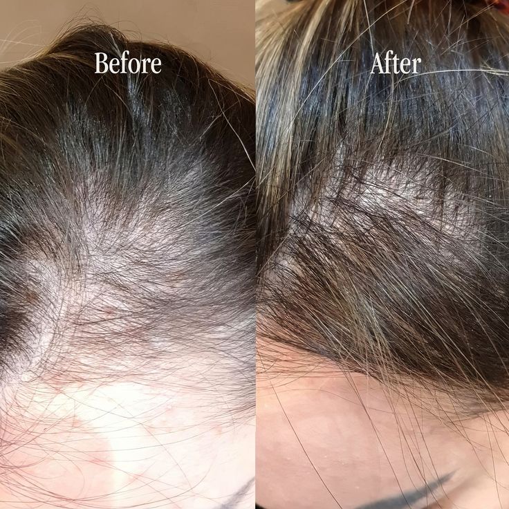 Noticeably less hair on the pillow and in the drain